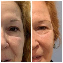 20245 04 14 Qué es una armonización facial (2)